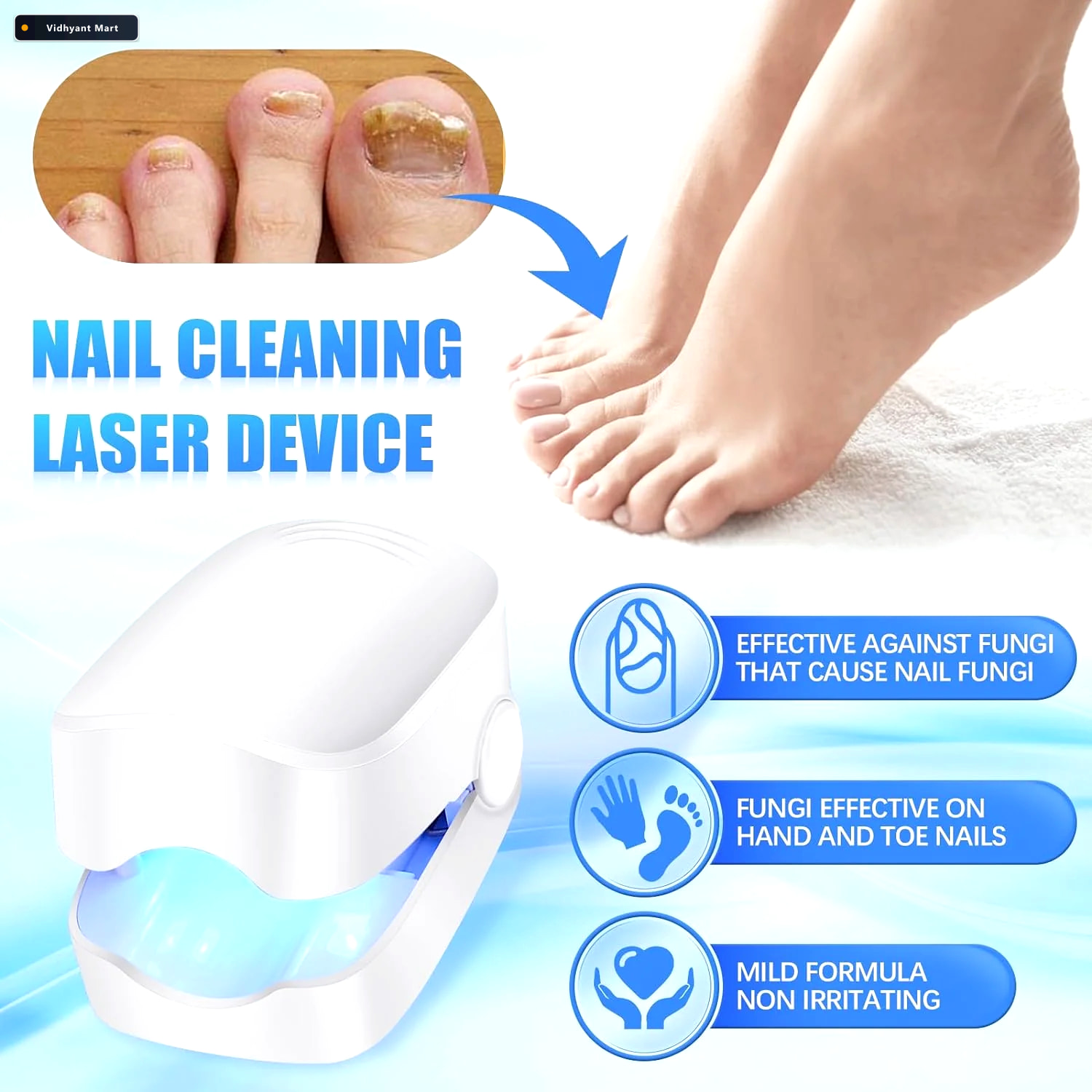 Vidhyant Mart Nail Fungus Laser Treatment Rechargeable Device Fo 3