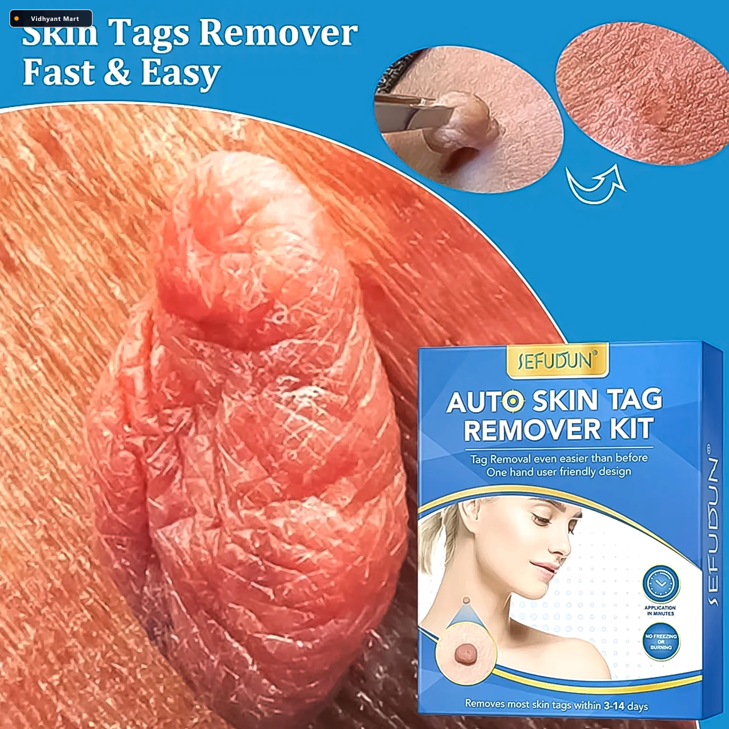 Vidhyant Mart Skin Tag Remover Kit For Face Care With Applicator 3